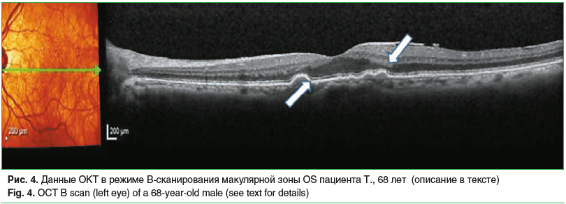 Рис. 4. Данные ОКТ в режиме B-сканирования макулярной зоны OS пациента Т., 68 лет (описание в тексте) Fig. 4. OCT B scan (left eye) of a 68-year-old male (see text for details)