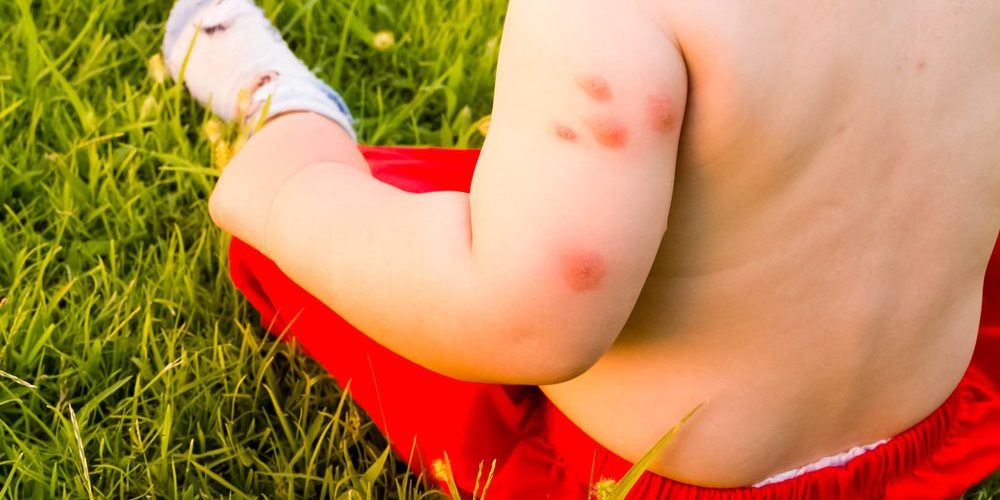 Что делать, если у вас аллергия на укусы комаров и мошек