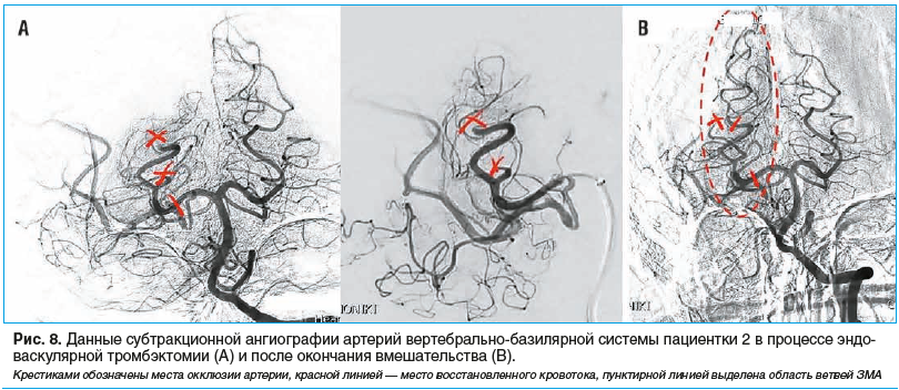 Рис. 8. Данные субтракционной ангиографии артерий вертебрально-базилярной системы пациентки 2 в процессе эндоваскулярной тромбэктомии (A) и после окончания вмешательства (B).