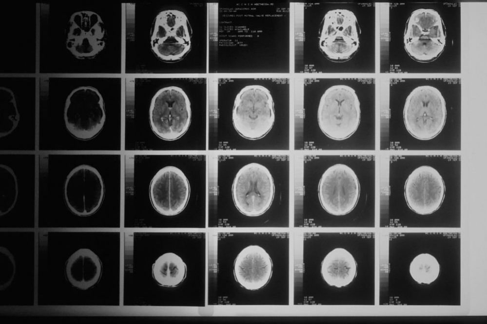 Стероиды способны изменить форму мозга