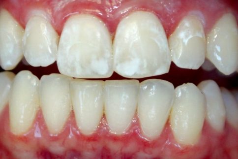 Почему на зубах появляются белые пятна и как их убрать