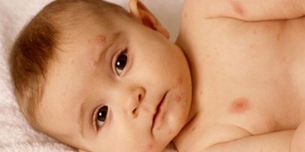 Главный миф о ветрянке развеяла педиатр Пальчикова