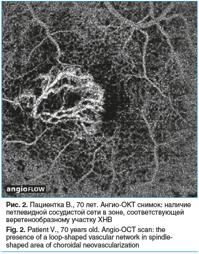 Рис. 2. Пациентка В., 70 лет. Ангио-ОКТ снимок: наличие петлевидной сосудистой сети в зоне, соответствующей веретенообразному участку ХНВ Fig. 2. Patient V., 70 years old. Angio-OCT scan: the presence of a loop-shaped vascular network in spindleshaped are