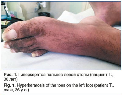 Рис. 1. Гиперкератоз пальцев левой стопы (пациент Т., 36 лет) Fig. 1. Hyperkeratosis of the toes on the left foot (patient T., male, 36 y.o.)