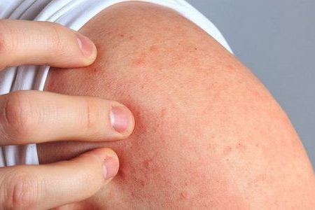 Терапевт Чурюкина назвала дерматит основным симптомом аллергии на холод