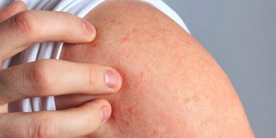 Терапевт Чурюкина назвала дерматит основным симптомом аллергии на холод