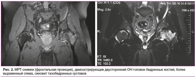 Рис. 2. МРТ-снимки (фронтальная проекция), демонстрирующие двусторонний ОН головок бедренных костей, более выраженный слева, синовит тазобедренных суставов