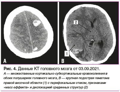 Рис. 4. Данные КТ головного мозга от 03.09.2021.