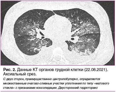 Рис. 2. Данные КТ органов грудной клетки (22.08.2021). Аксиальный срез.