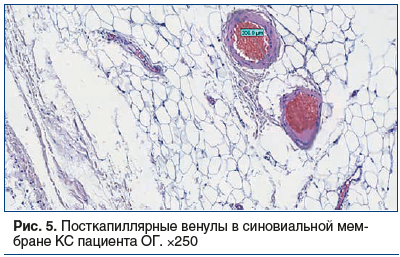 Рис. 5. Посткапиллярные венулы в синовиальной мембране КС пациента ОГ. ×250