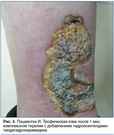 Рис. 5. Пациентка И. Трофическая язва после 1 мес. комплексной терапии с добавлением гидроксиэтилдиметилдигидропиримидина