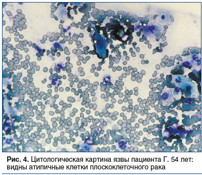 Рис. 4. Цитологическая картина язвы пациента Г. 54 лет: видны атипичные клетки плоскоклеточного рака
