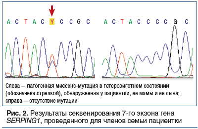 Рис. 2. Результаты секвенирования 7-го экзона гена SERPING1, проведенного для членов семьи пациентки