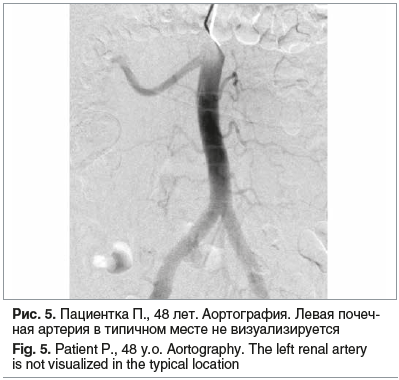 Рис. 5. Пациентка П., 48 лет. Аортография. Левая почеч- ная артерия в типичном месте не визуализируется Fig. 5. Patient P., 48 y.o. Aortography. The left renal artery is not visualized in the typical location