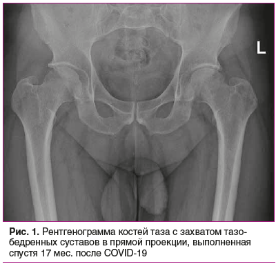 Рис. 1. Рентгенограмма костей таза с захватом тазо- бедренных суставов в прямой проекции, выполненная спустя 17 мес. после COVID-19