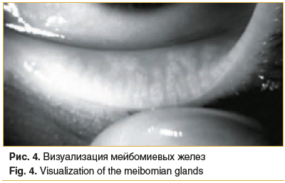 Рис. 4. Визуализация мейбомиевых желез Fig. 4. Visualization of the meibomian glands
