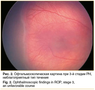 Рис. 2. Офтальмоскопическая картина при 3-й стадии РН, неблагоприятный тип течения Fig. 2. Ophthalmoscopic findings in ROP, stage 3, an unfavorable course