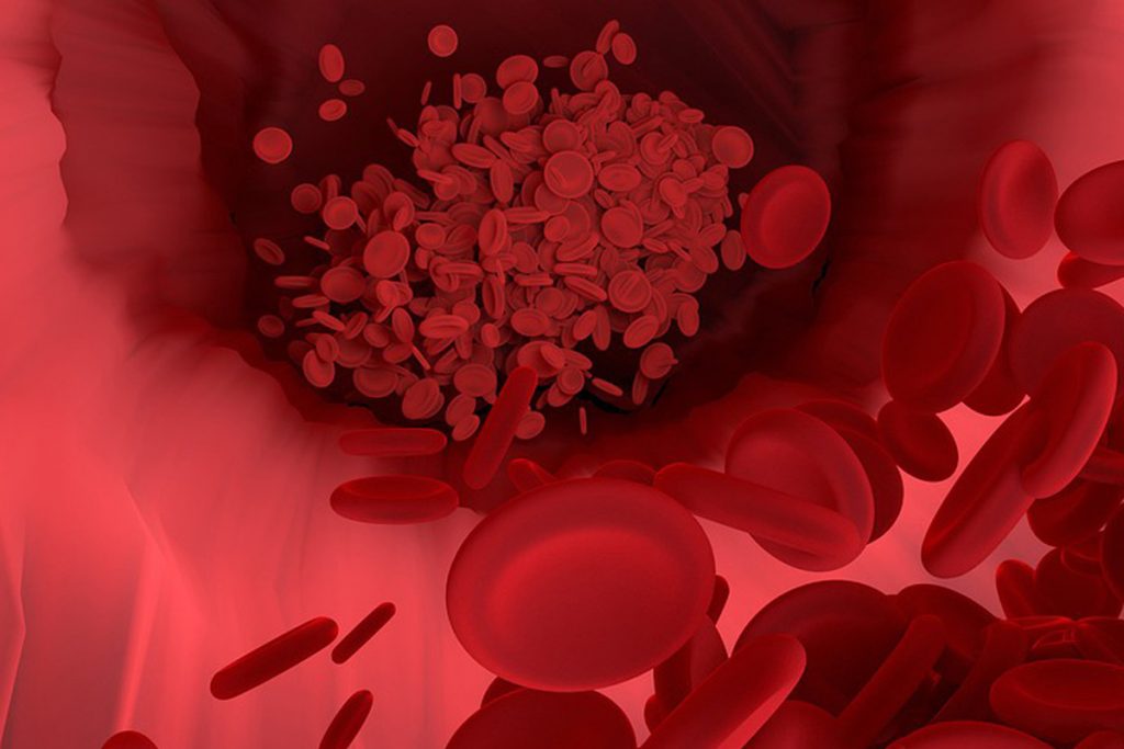 Как можно почистить сосуды на самом деле