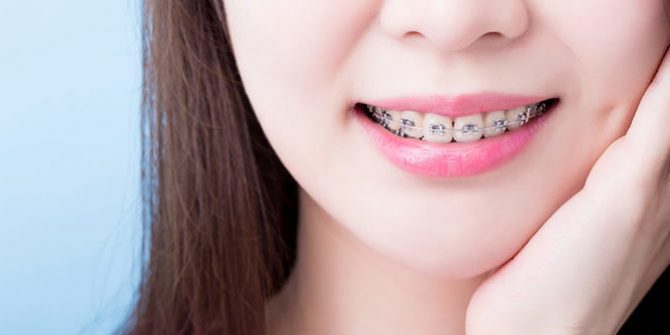 Почему люди носят брекеты дольше положенного срока