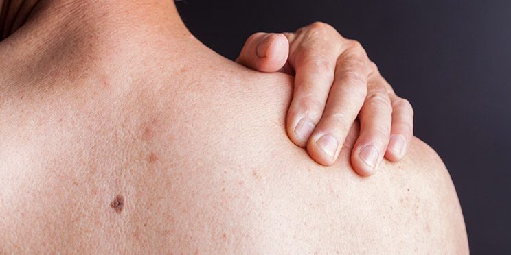 Стало известно, как людям с псориазом ухаживать за кожей весной