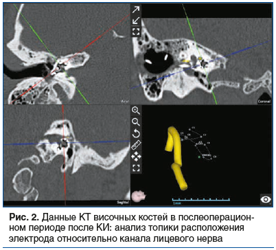 Рис. 2. Данные КТ височных костей в послеоперационном периоде после КИ: анализ топики расположения электрода относительно канала лицевого нерва