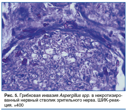 Рис. 5. Грибковая инвазия Aspergillus spp. в некротизированный нервный стволик зрительного нерва. ШИК-реакция. ×400