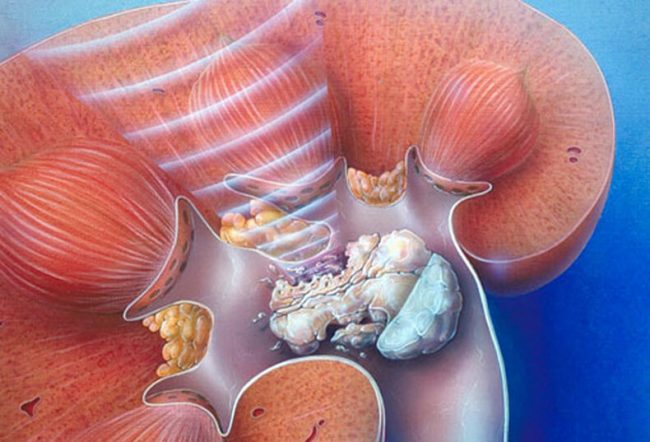 Камни в почках: как не упустить ранние признаки формирования