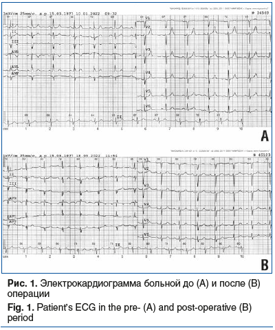 Рис. 1. Электрокардиограмма больной до (А) и после (В) операции Fig. 1. Patient’s ECG in the pre- (A) and post-operative (B) period