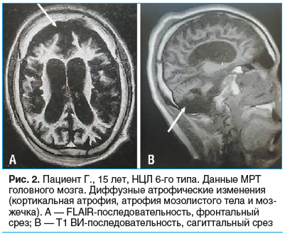 Рис. 2. Пациент Г., 15 лет, НЦЛ 6-го типа. Данные МРТ головного мозга. Диффузные атрофические изменения (кортикальная атрофия, атрофия мозолистого тела и моз- жечка). А — FLAIR-последовательность, фронтальный срез; B — Т1 ВИ-последовательность, сагиттальн
