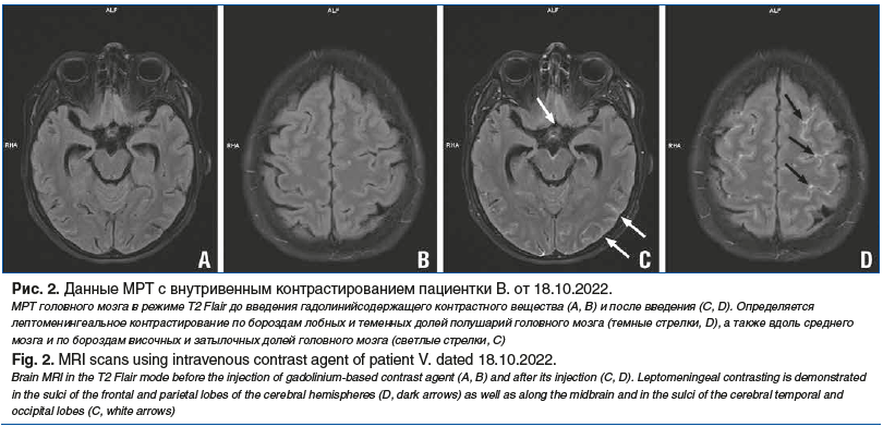 Рис. 2. Данные МРТ с внутривенным контрастированием пациентки В. от 18.10.2022. МРТ головного мозга в режиме T2 Flair до введения гадолинийсодержащего контрастного вещества (A, B) и после введения (C, D). Определяется лептоменингеальное контрастирование п