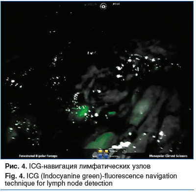 Рис. 4. ICG-навигация лимфатических узлов Fig. 4. ICG (Indocyanine green)-fluorescence navigation technique for lymph node detection