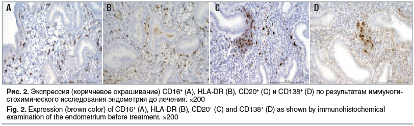 Рис. 2. Экспрессия (коричневое окрашивание) CD16+ (A), HLA-DR (B), CD20+ (C) и CD138+ (D) по результатам иммуноги- стохимического исследования эндометрия до лечения. ×200 Fig. 2. Expression (brown color) of CD16+ (A), HLA-DR (B), CD20+ (C) and CD138+ (D) 