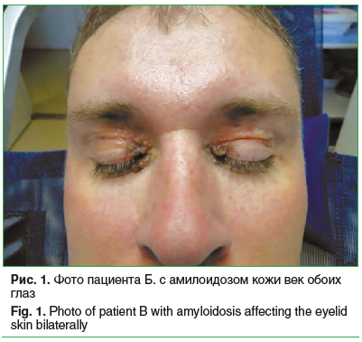 Рис. 1. Фото пациента Б. с амилоидозом кожи век обоих глаз Fig. 1. Photo of patient B with amyloidosis affecting the eyelid skin bilaterally