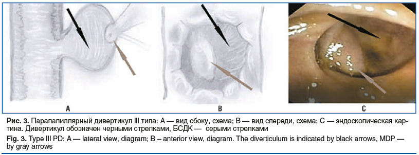Рис. 3. Парапапиллярный дивертикул III типа: А — вид сбоку, схема; В — вид спереди, схема; С — эндоскопическая кар- тина. Дивертикул обозначен черными стрелками, БСДК — серыми стрелками Fig. 3. Type III PD: A — lateral view, diagram; B – anterior view, di
