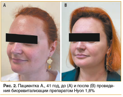 Рис. 2. Пациентка А., 41 год, до (А) и после (В) проведения биоревитализации препаратом Hyon 1,8%