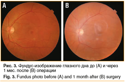 Рис. 3. Фундус-изображение глазного дна до (А) и через 1 мес. после (В) операции Fig. 3. Fundus photo before (A) and 1 month after (B) surgery