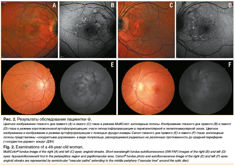 Рис. 2. Результаты обследования пациентки Ф. Цветное изображение глазного дна правого (A) и левого (С) глаза в режиме MultiColor: ангиоидные полосы. Изображение глазного дна правого (B) и левого (D) глаза в режиме коротковолновой аутофлуоресценции: очаги 