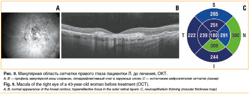 Рис. 9. Макулярная область сетчатки правого глаза пациентки Л. до лечения, ОКТ. A, B — профиль макулярной зоны сохранен, гиперрефлективный очаг в наружных слоях; C — истончение нейроэпителия сетчатки (схема) Fig. 9. Macula of the right eye of a 43-year-ol