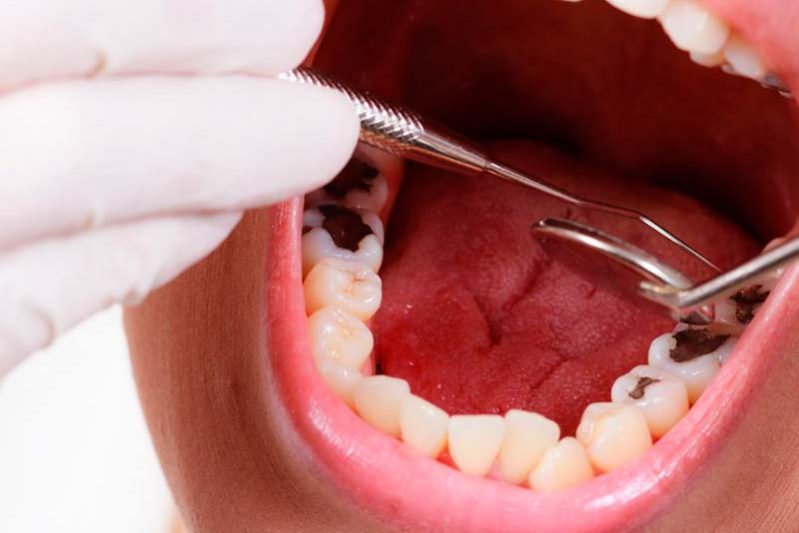 Кариес: причины, лечение, профилактика — Медицина 2.0