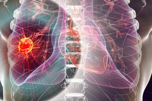 Алектиниб показывает положительные результаты в III фазе исследования при ALK-положительном