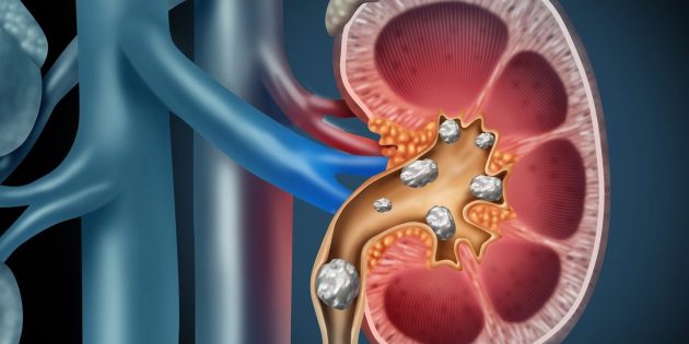 Врачи указали на неочевидную причину камней в почках