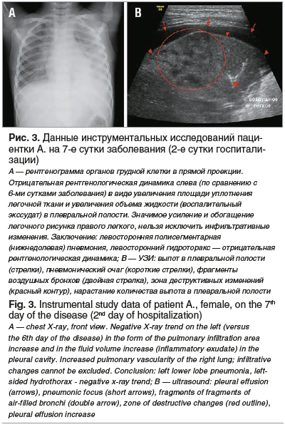 Рис. 3. Данные инструментальных исследований паци- ентки А. на 7-е сутки заболевания (2-е сутки госпитали- зации) А — рентгенограмма органов грудной клетки в прямой проекции. Отрицательная рентгенологическая динамика слева (по сравнению с 6-ми сутками заб