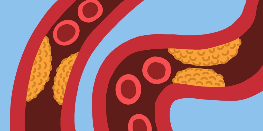 Что т акое атеросклероз и как его предотвратить