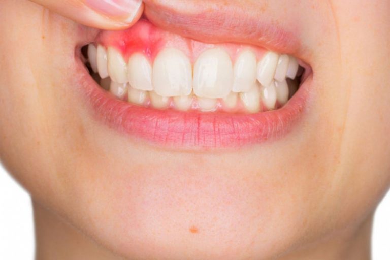 Кровоточат десны: в чем причина и как быстро себе помочь