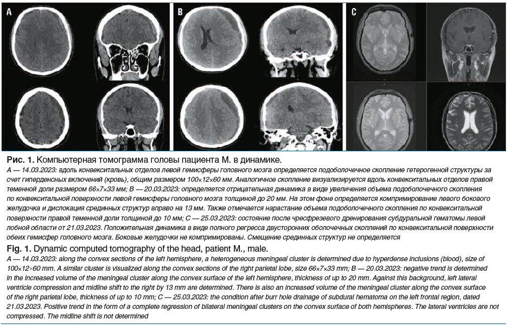 Рис. 1. Компьютерная томограмма головы пациента М. в динамике. А — 14.03.2023: вдоль конвекситальных отделов левой гемисферы головного мозга определяется подоболочечное скопление гетерогенной структуры за счет гиперденсных включений (кровь), общим размеро