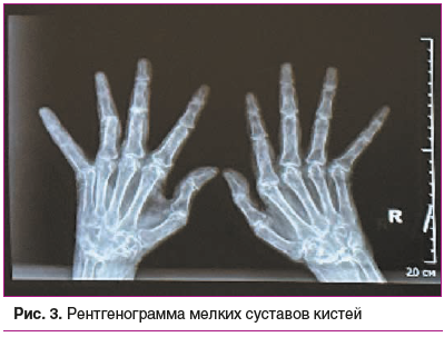 Рис. 3. Рентгенограмма мелких суставов кистей
