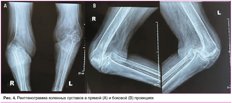 Рис. 4. Рентгенограмма коленных суставов в прямой (A) и боковой (B) проекциях