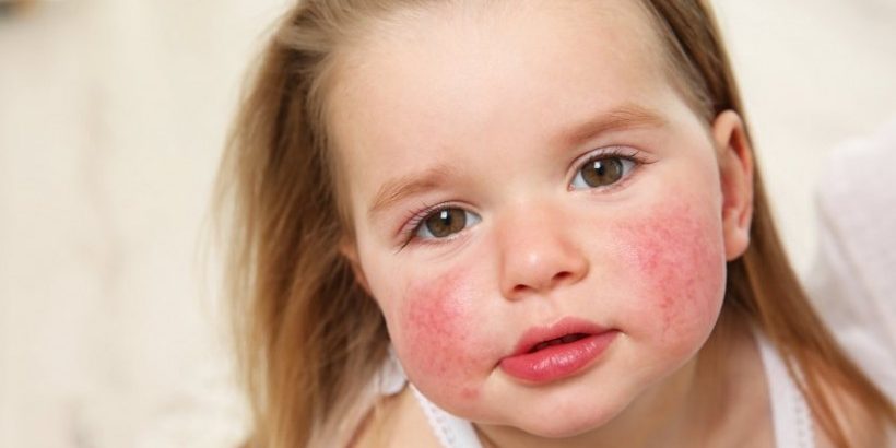 Можно ли навсегда избавиться от аллергии