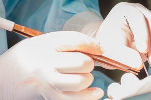 Врачи Клиники СПбГУ пересадили ребенку палец его мамы