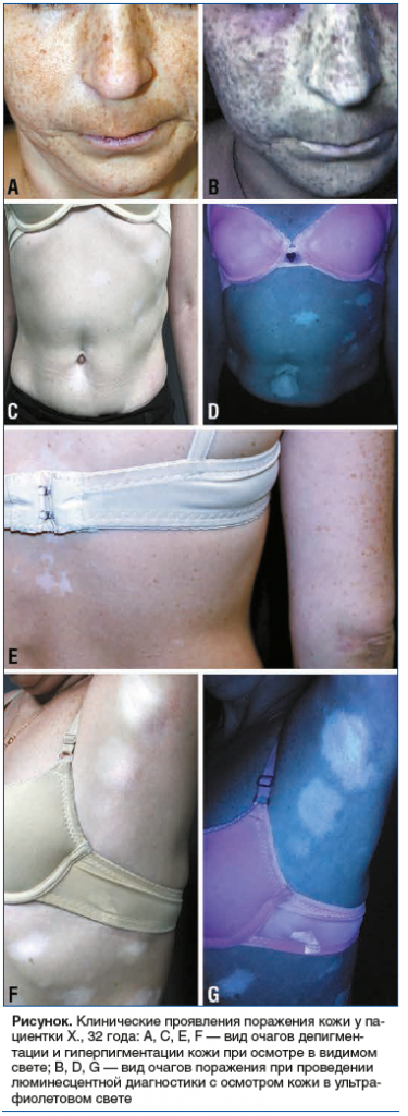 Рисунок. Клинические проявления поражения кожи у па- циентки Х., 32 года: A, C, E, F — вид очагов депигмен- тации и гиперпигментации кожи при осмотре в видимом свете; B, D, G — вид очагов поражения при проведении люминесцентной диагностики с осмотром кожи